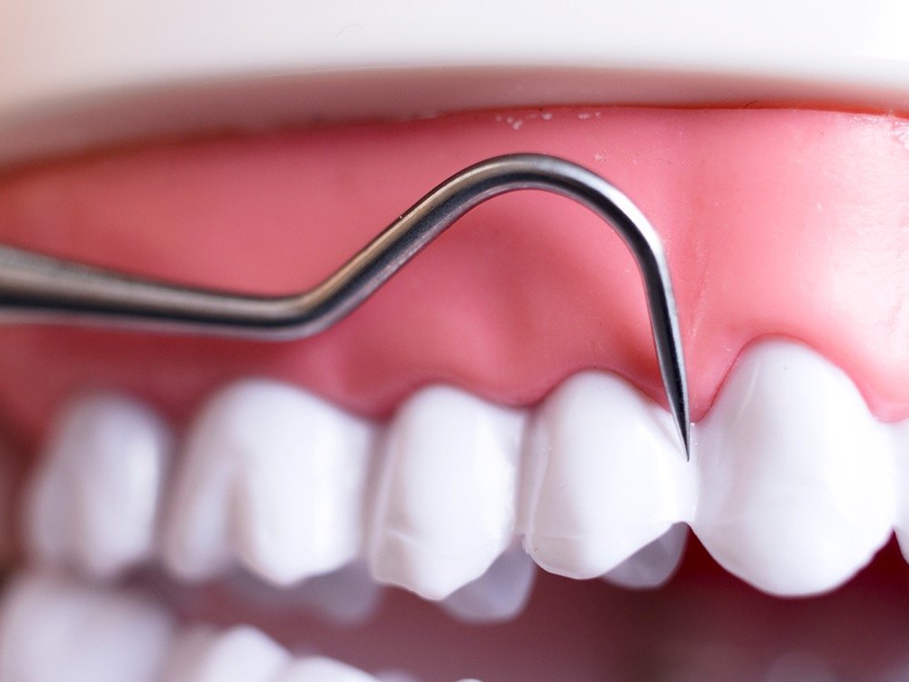 Diş Taşı Temizliği